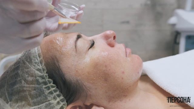 PRX-T33 пилинг химический аналог биоревитализации