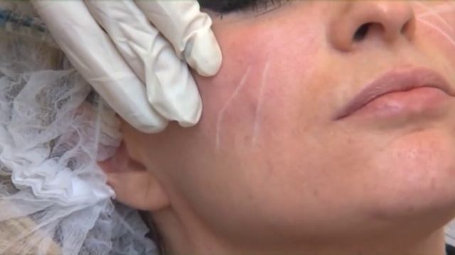 Stylage XL - коррекция скул