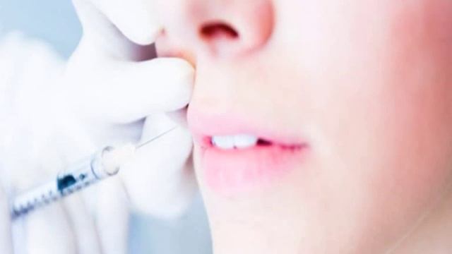 Radiesse Volume Lifting