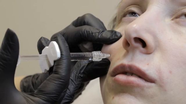 Коррекция лица филлерами Excellent