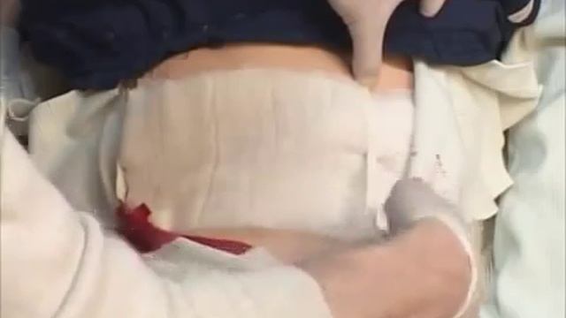 Проникающая травма живота, 5 мин.