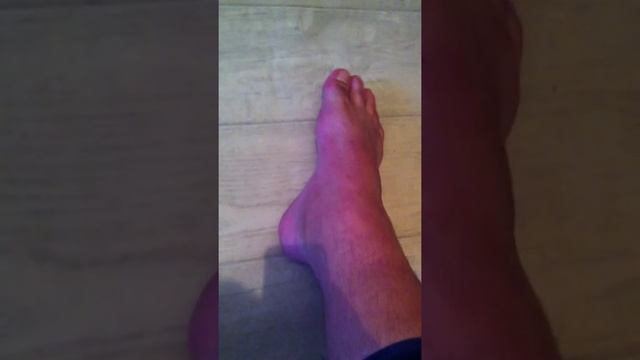 Перелом наружной лодыжки.