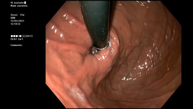Gastroscopy With Surprice | Gastroscopia Con Sorpresa | Inappropriate - Inappropriato