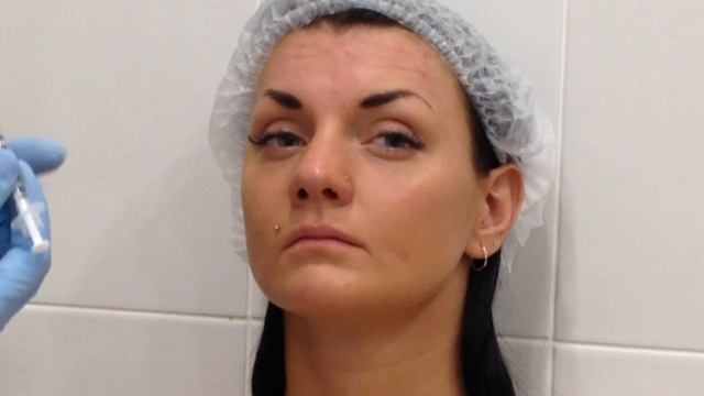 АирисКом: Студенты учатся. Экзамен по БОТУЛОТОКСИНУ. РАЗМЕТКА на лбу и выполнение инъекций.