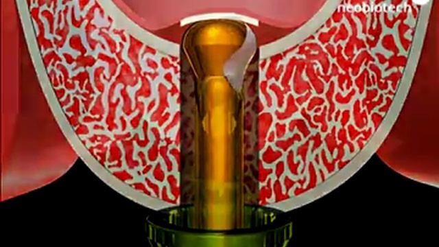 Sinus Lateral Approach Kit EN - Dental Implant