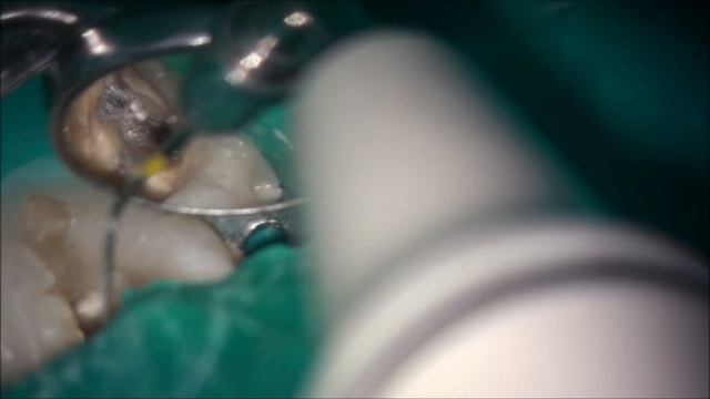 Опять , ступени и механизмы обхождения