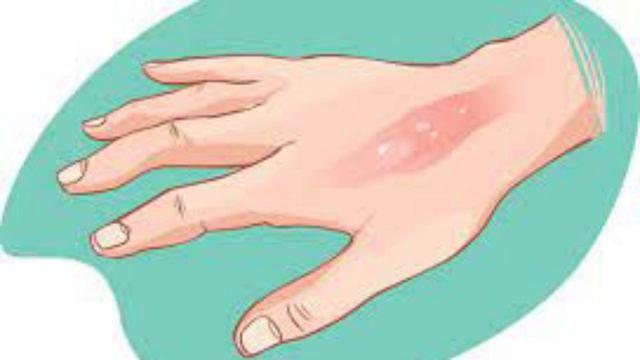 EQUINÁCEA:  Auxilia No Tratamento De CÂNCER De PÂNCREAS E INTESTINO, Regula A GLICEMIA No SANGUE E.