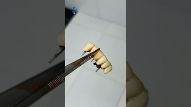 Металлокерамические коронки заставили пациента ставить имплантаты. Имплантация зубов.