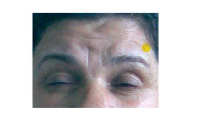 Блефароспазм. Ошибка или...?