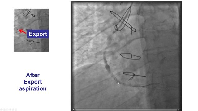 Case 38: PCI Manual: No Reflow During SVG PCI