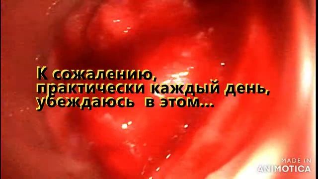 Рак прямой кишки