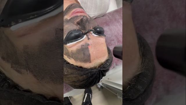 Карбоновый пилинг