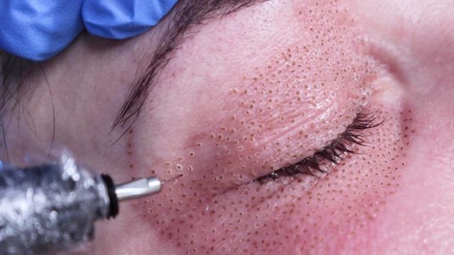Plasma Pen Fibroblast Treatment Lower & Upper Eyelids - BEFORE & AFTER Transformation (2022)