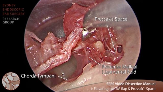 Step 1 - Sydney Endoscopic Ear Surgery Video Dissection Manual