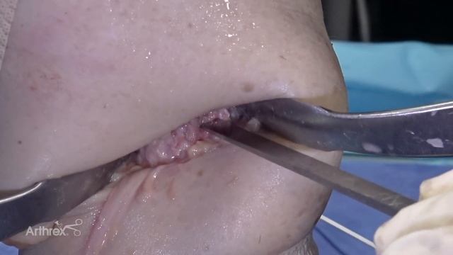 Subpectoral Biceps Tenodesis Using A 1.9 Mm FiberTak® Anchor With Needles