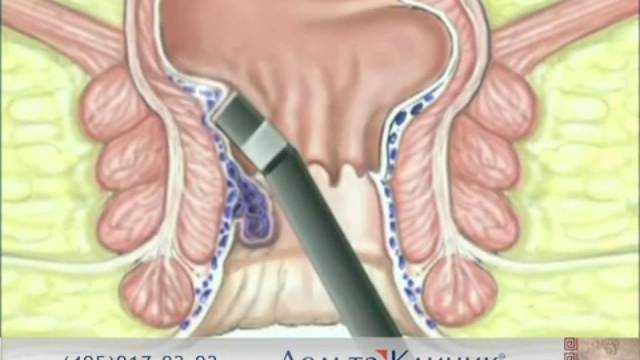 Лечение геморроя в ДЕЛЬТАКЛИНИК!