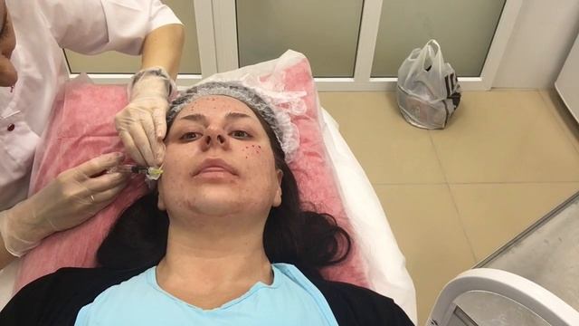 УКОЛЫ КРАСОТЫ | Филлеры и Биоревитализация |