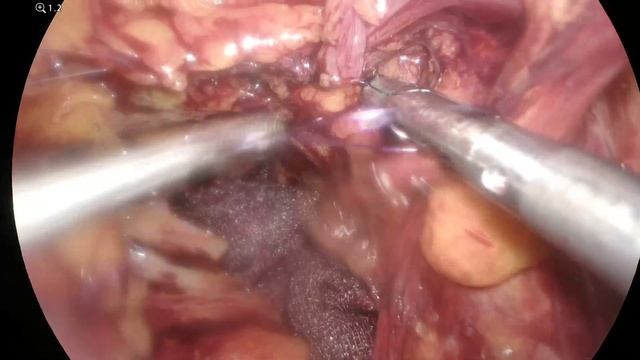 Прямая паховая грыжа справа/ Direct Inguinal Hernia Right PM2 TAPP