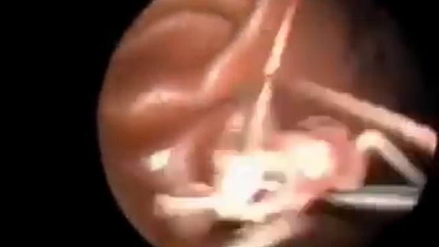 Из головы индуса врачи вытащили сверчка гиганта