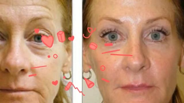 3D Sculptaderm RF  Skin Tightening & Body Sculpting