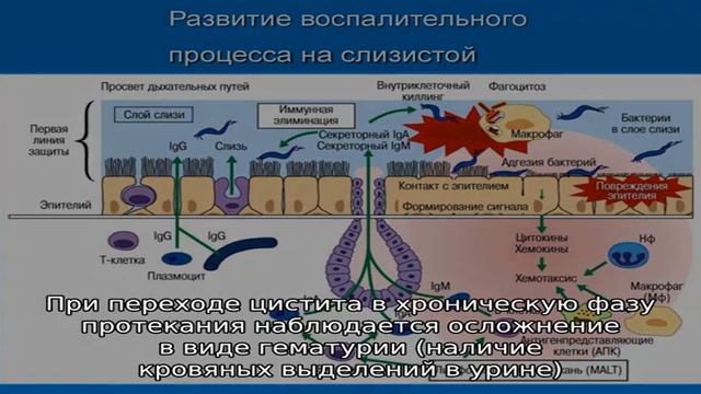 Особенности протекания и лечения цистита и уреаплазмоза