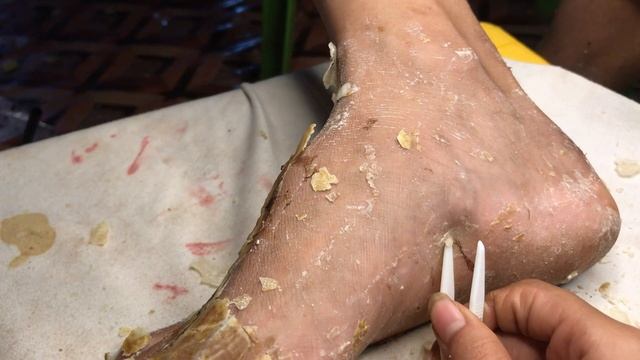 How to removal skin  callus removal skin flakes 08