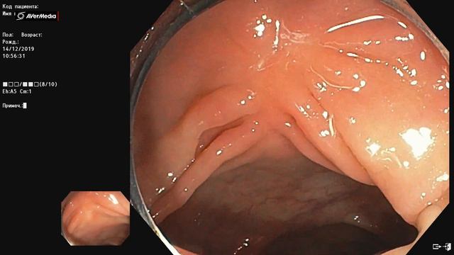 Рубец после холодной полипэктомии