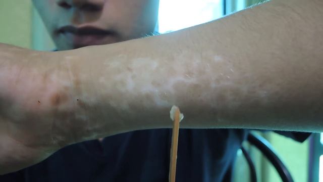 MI TRATAMIENTO PARA EL VITILIGO - ACTIVIDAD SOLAR [Dj Duvan]