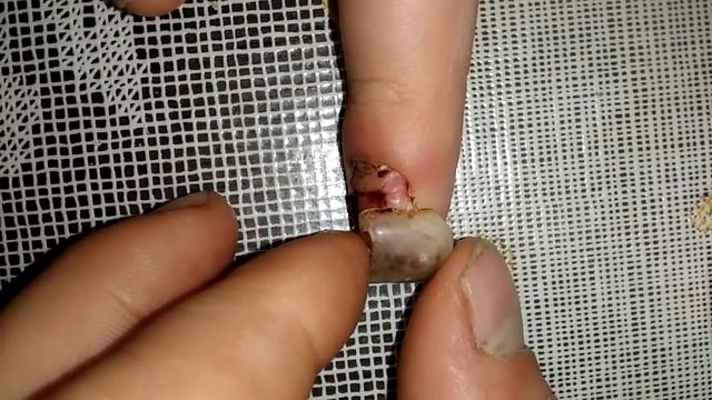 Слабонервным не смотреть!!!!Пытаюсь оторвать разбитый ноготь