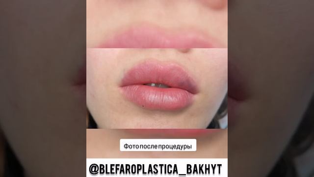 Увеличение губ @blefaroplastica_bakhyt филлерами! Гиалуроновая кислота