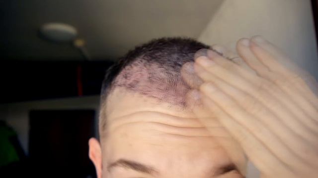 FUE Hair Transplant 82 Days (post Op) Istanbul, Turkey GROWTH STAGE