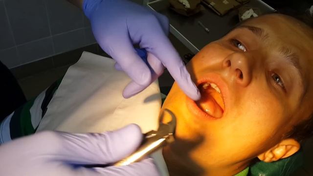 Удаление зуба мудрости (полуретинированной восьмерки) прямым элеватором.