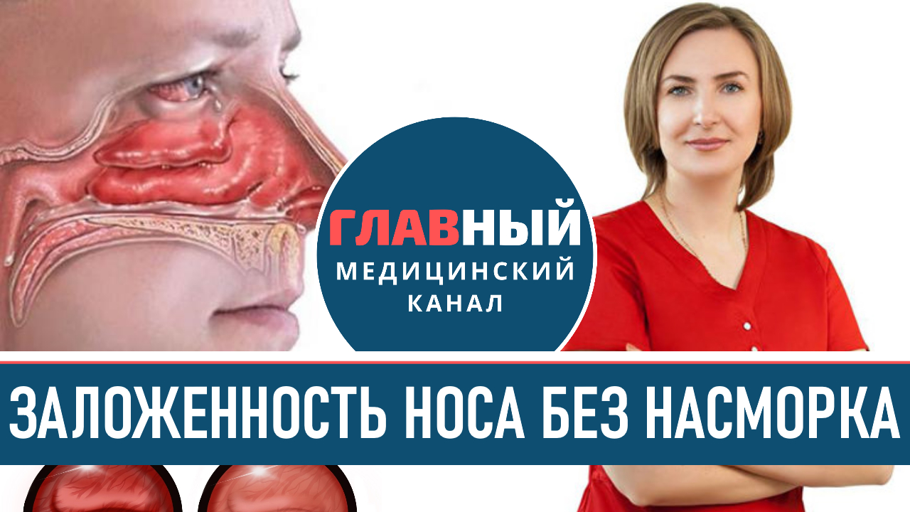 Вазомоторный Ринит. Заложенность Носа без насморка. Хронический ринит и гайморит
