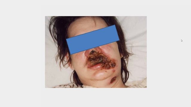 Диагностика ранних форм сифилиса