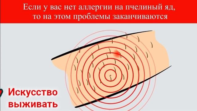 Вот что делать если ваш укусила Пчела Интересные факты про Пчёл и Ос Берегите своё здоровье