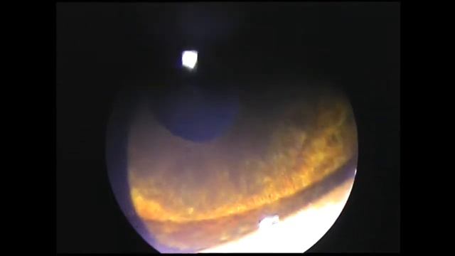 Хронический иридоциклит