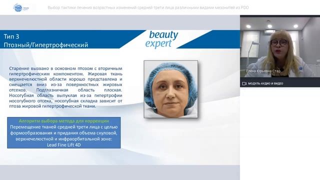 Выбор тактики лечения возрастных изменений средней трети лица различными видами мезонитей из PDO
