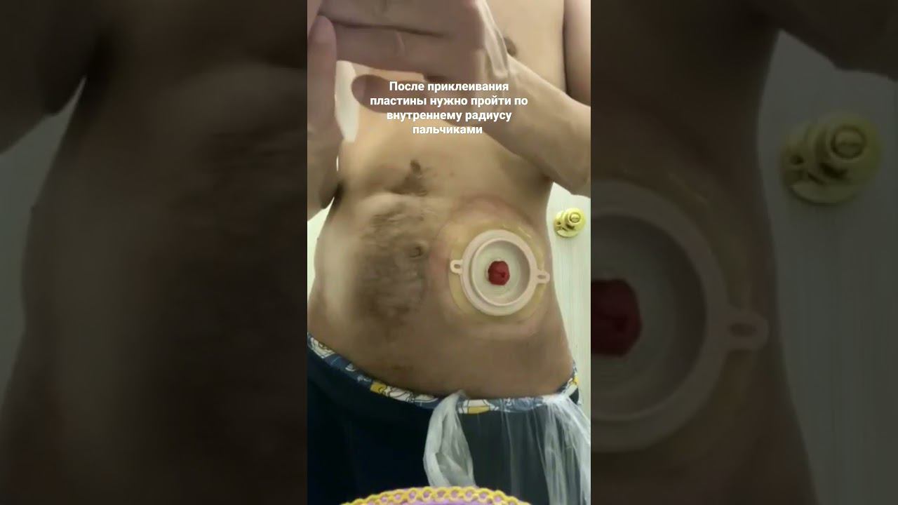 Как приклеить конвексную пластину калоприемника стома