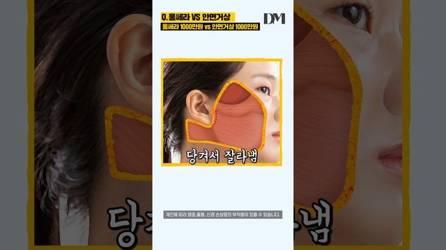 1000만원 주고 받을거면 이걸 받아야지 !!?#shorts #울쎄라 #안면거상 #1000만원