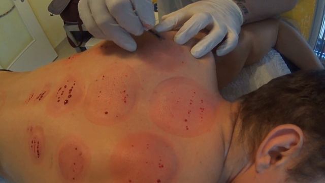 Кровопускание Хиджама