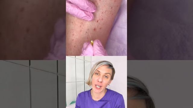 Вросшие волосы? #вросшийволос #волосы #лазернаяэпиляция