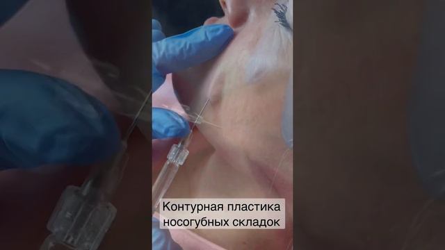 Контурная пластика носогубных складок