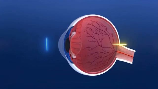 Alcon Acrysof IQ Vivity LENS: एक लख खरच करन worth ह?