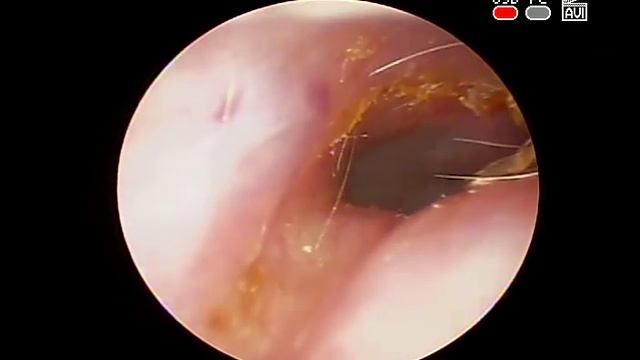 Острый наружный и средний #отит #воспаление наружного и среднего #уха КЛИНИКА ОБРАЗЦОВА