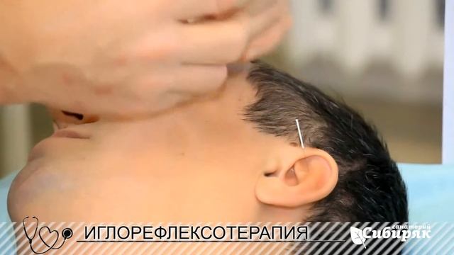 Иглоукалывание