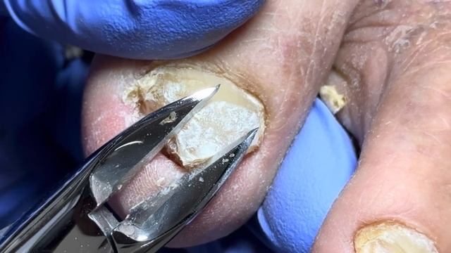 Wow~ Trim Thick Onychomycosis And There Is Nothing Under The Nails.【Doctor Liu Pedicure】