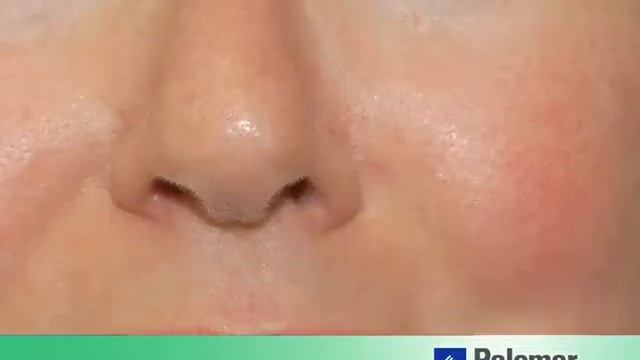 Фракционный лазер Palomar в лечении купероза