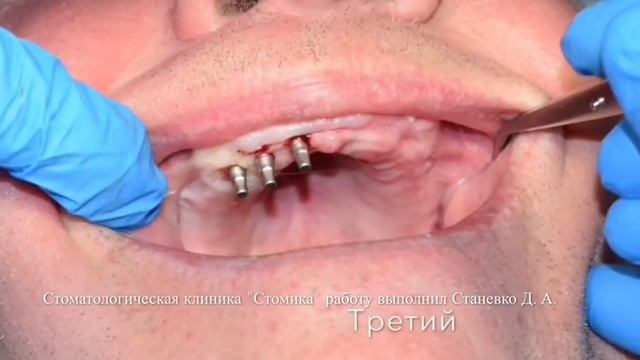 Одноэтапная базальная имплантация зубов в Беларуси в клинике 