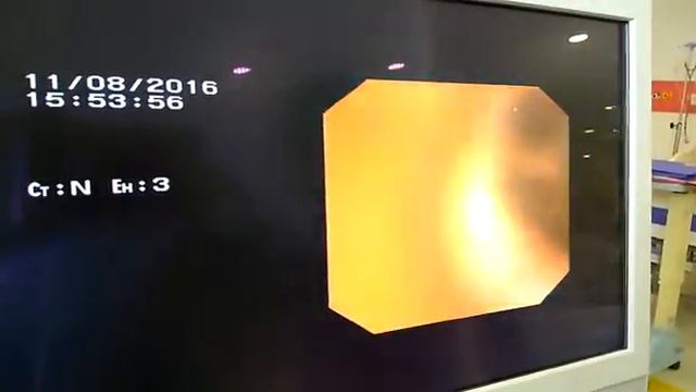 Brochoscopic Finding  In A Patient Diagnosed With Aspergillus Niger And Klebsiella Pneumoniae