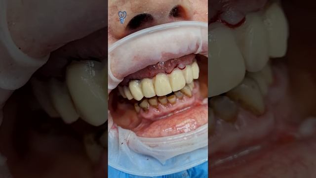 За 2 часа удалили 10 зубов и поставили новые на верхнюю челюсть. Имплантация зубов.